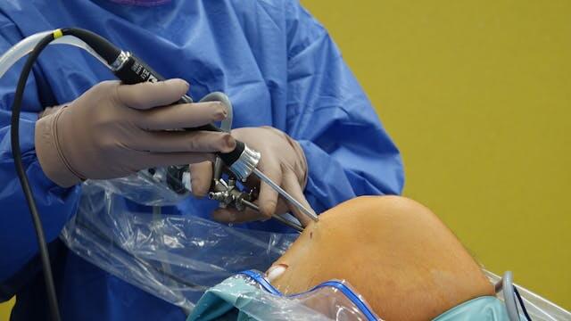 West China Hospital's Bone Banking Innovation Transforms Hip Revision Surgery